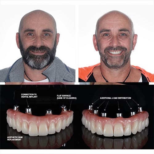 beylikdüzü all on four implant