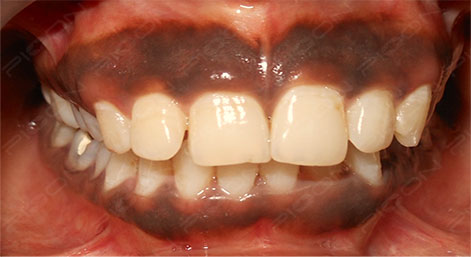 How to treat of Gingival Melanin Hyperpigmentation？