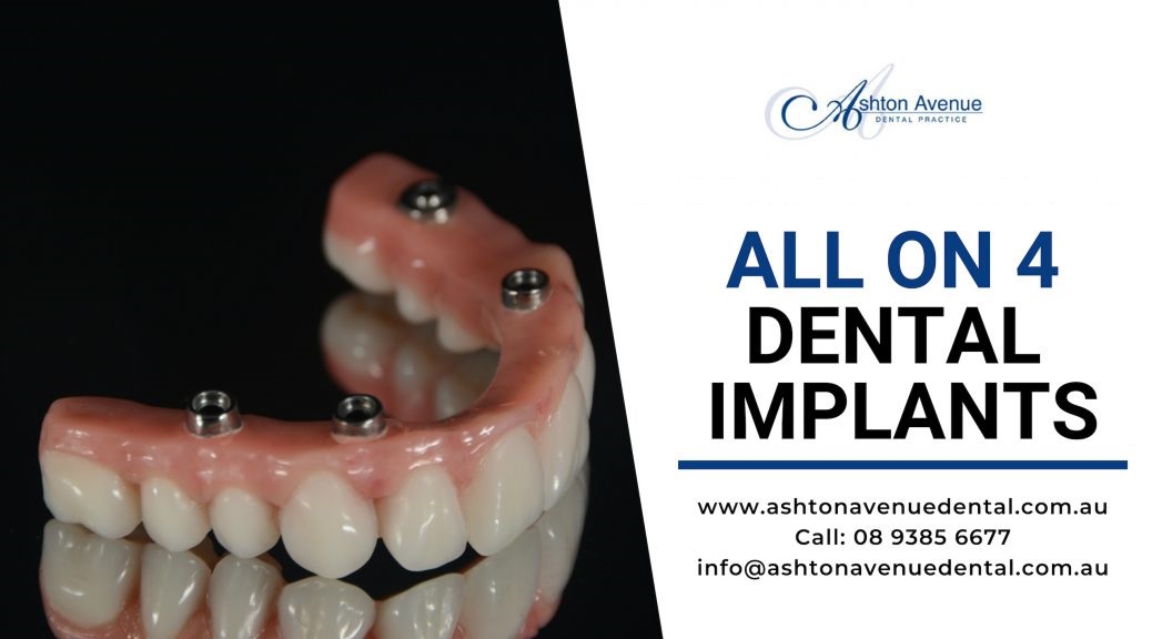 What is The Process of All-on-4 Dental Implants?