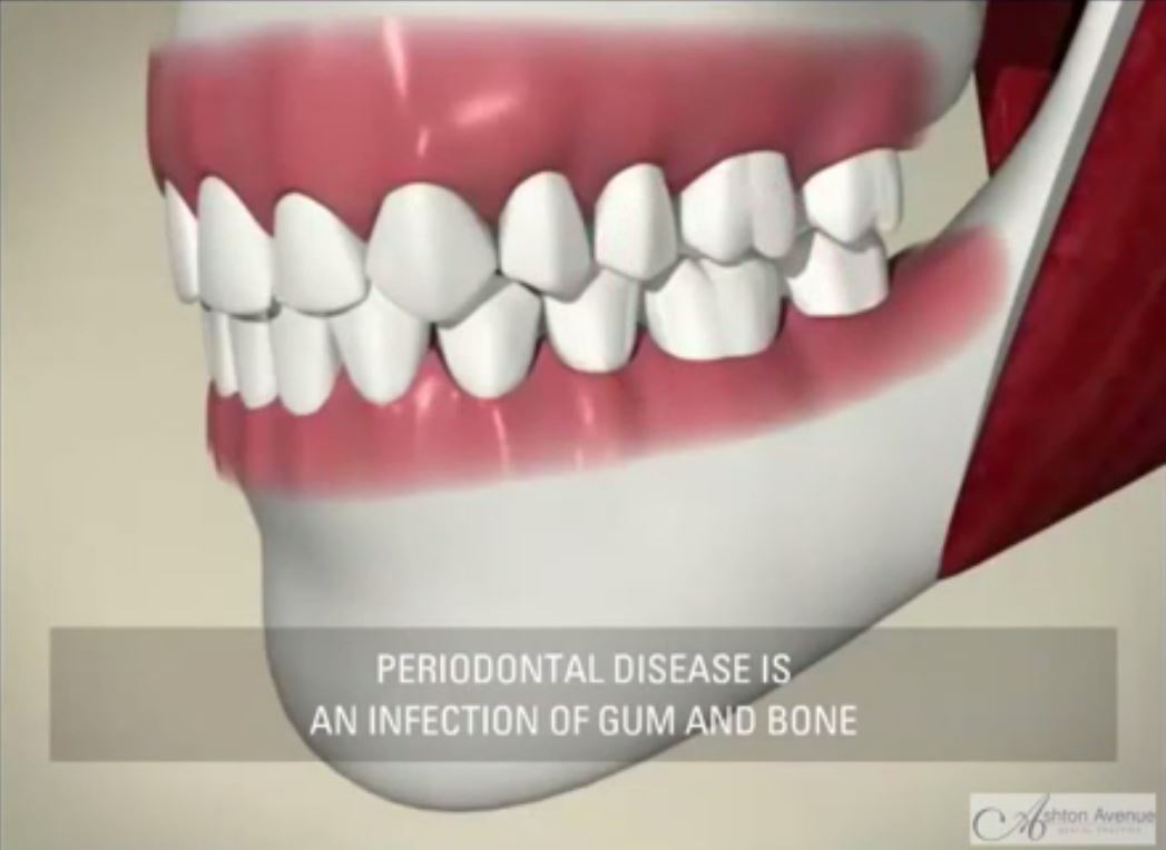 What is Periodontal Disease? - YouTube