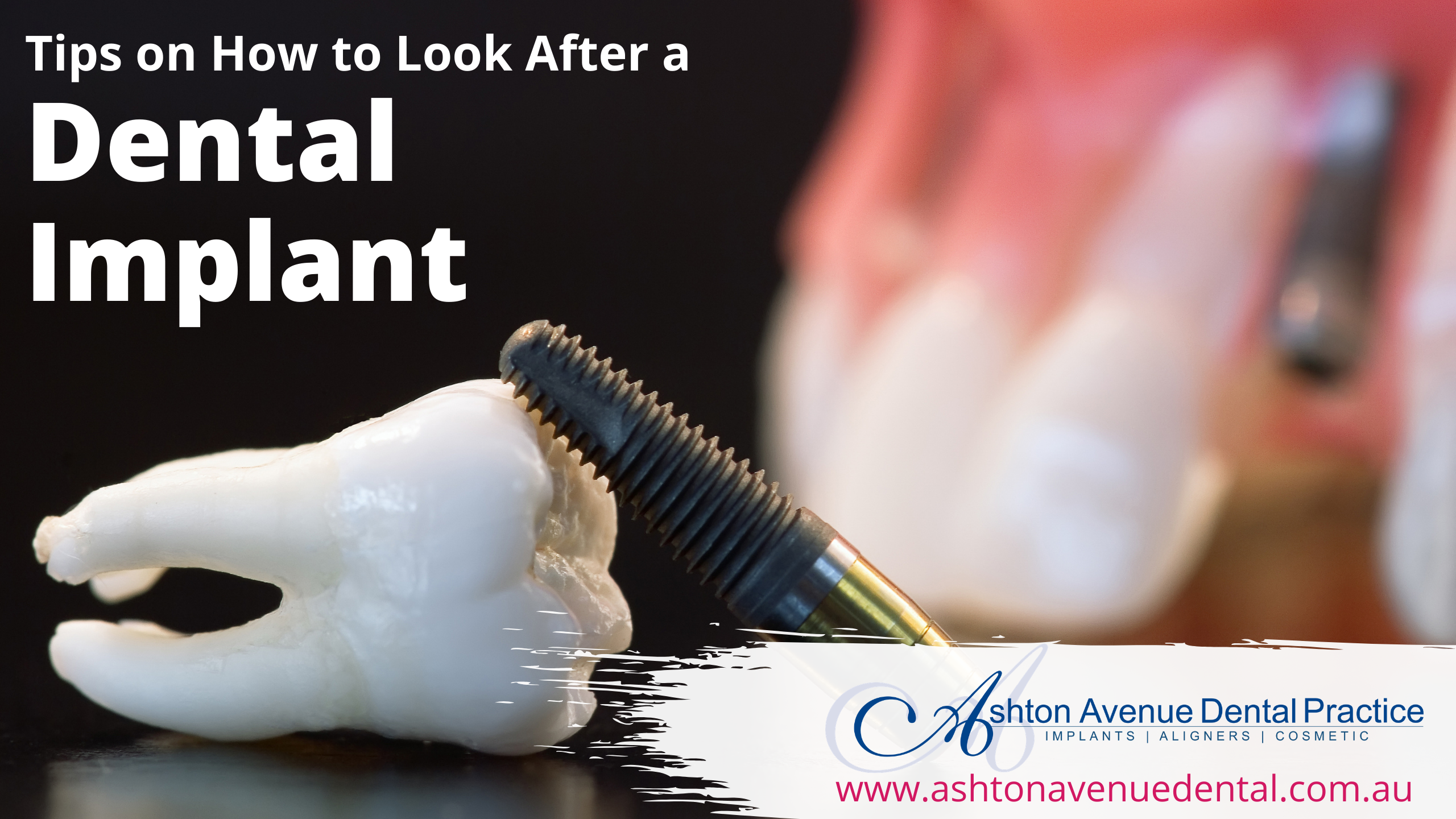Dental Implant Treatment Procedure: A Step by Step Guide