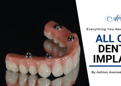 What are All on 4 Dental Implants?
