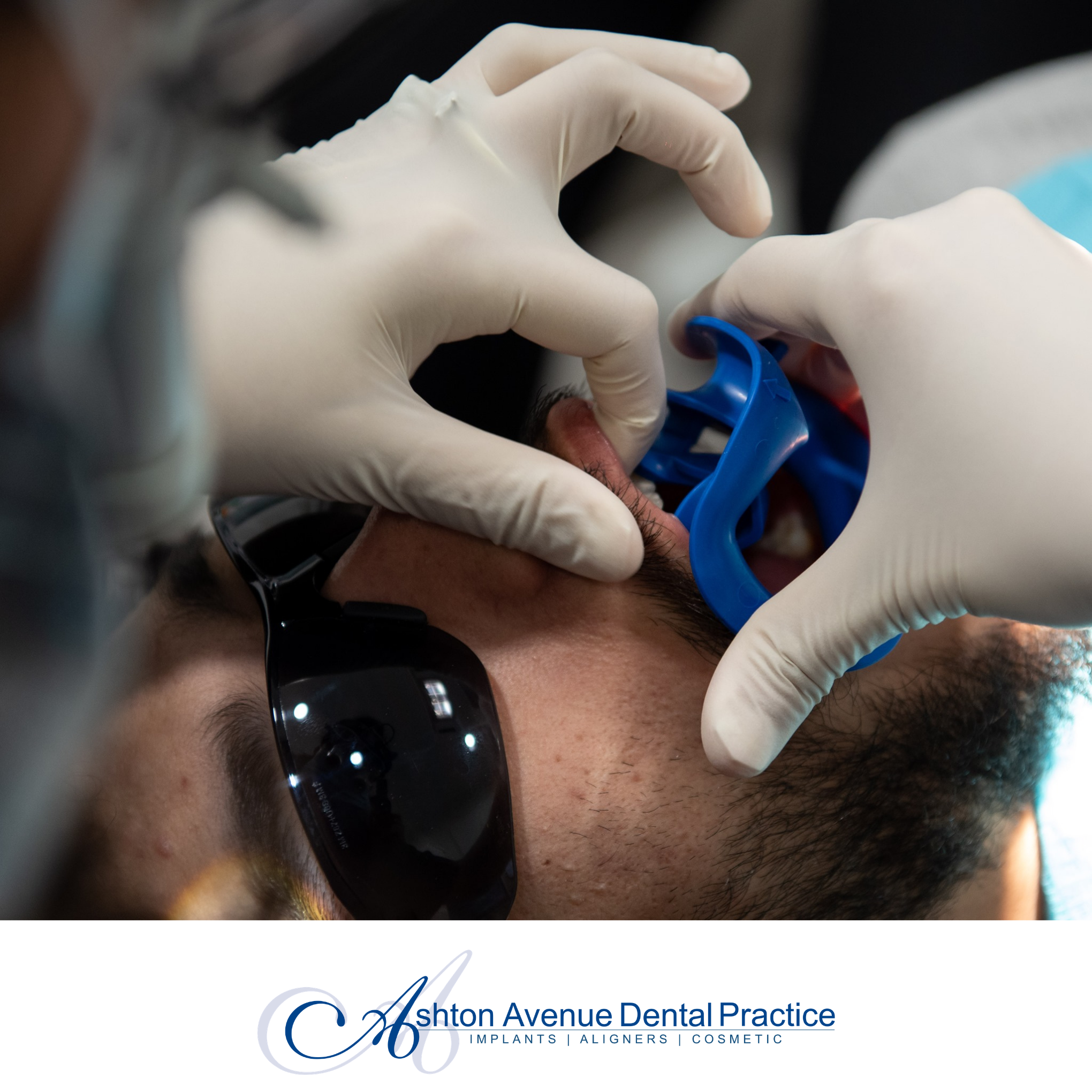 Porcelain Crowns and Veneers Claremont, Perth