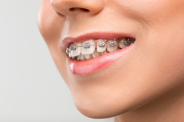7 Tips to Find the Right Orthodontic Treatment for You in Claremont