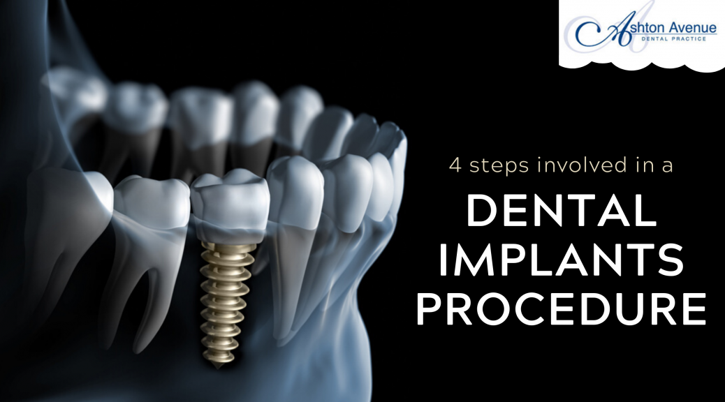 Dental implants procedure: what are the 4 steps involved?