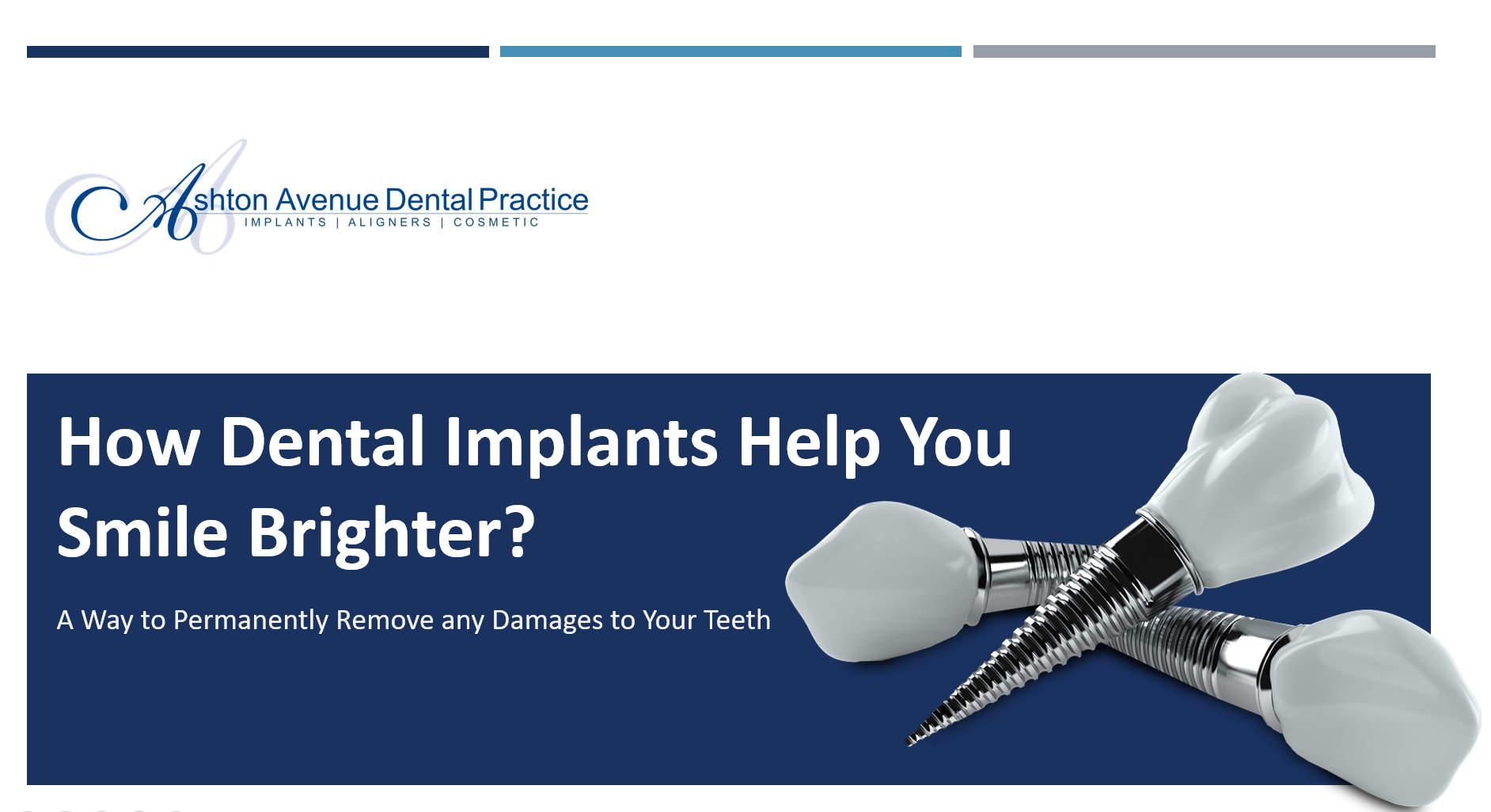 Some Guidelines About Dental Implants