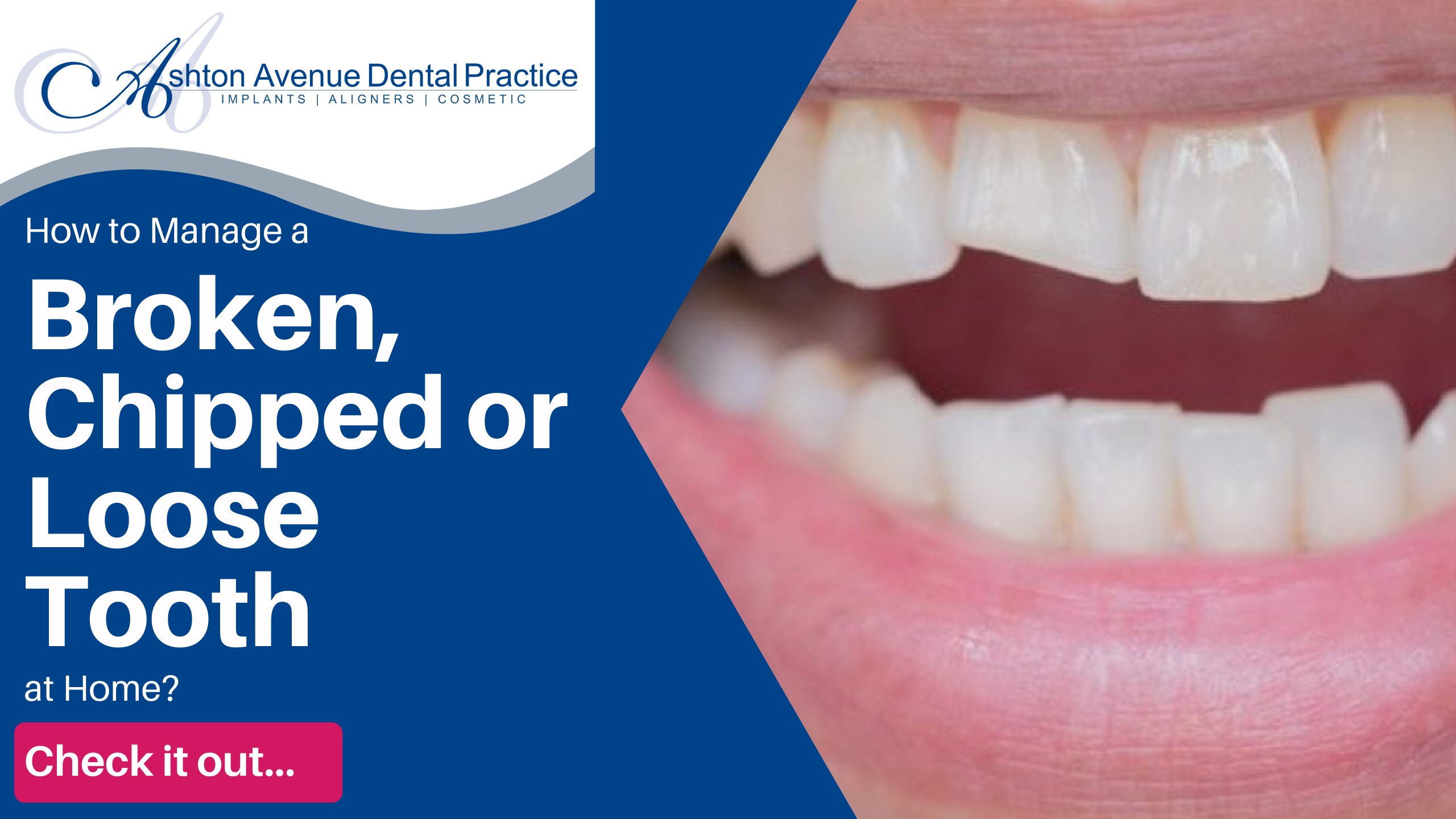 How to Manage a Broken, Chipped or Loose Tooth at Home?