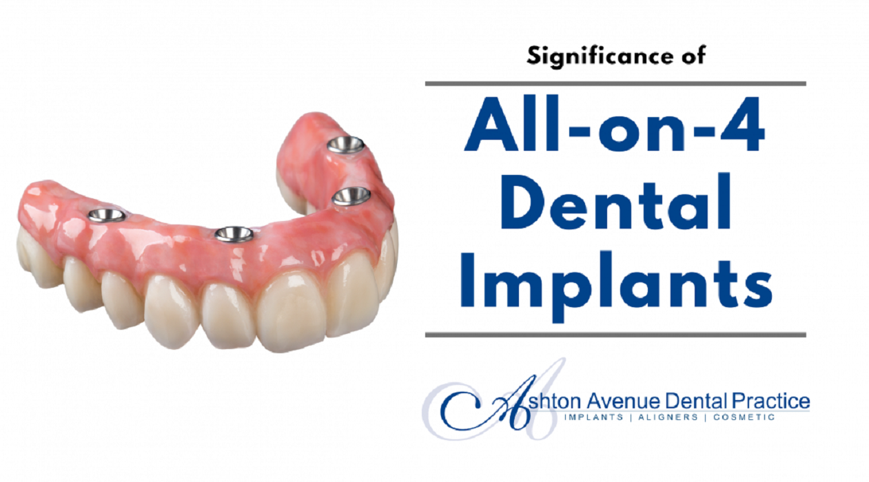 All-on-4 Dental Implants – All on Four Implants Claremont