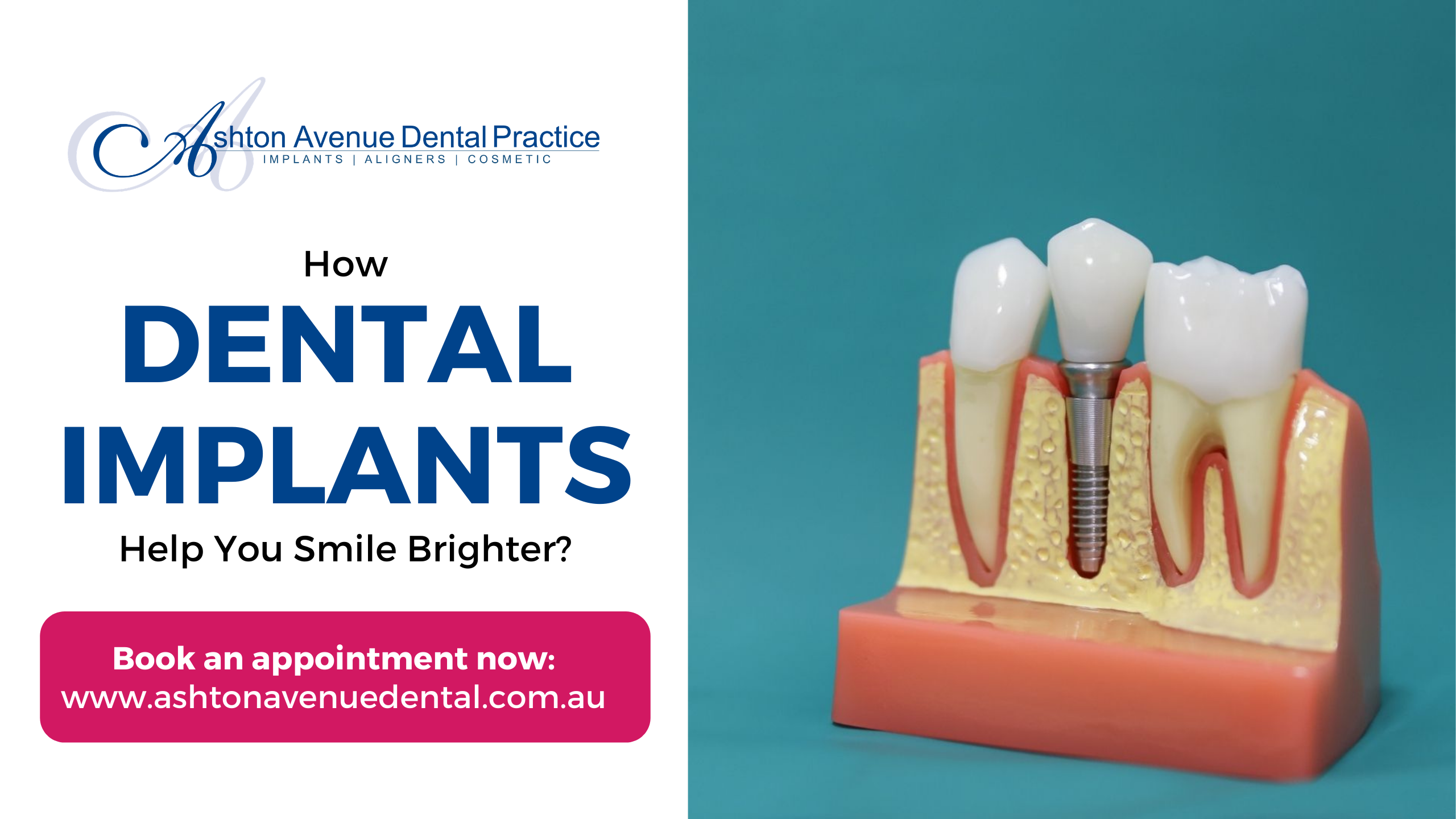 Want to Smile Brighter? Discover How Dental Implants Help You