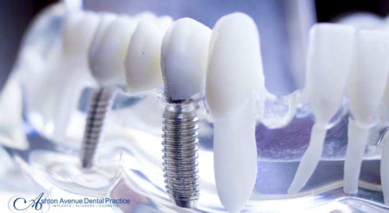 Dental Implants: What You Need to Know Before You Go