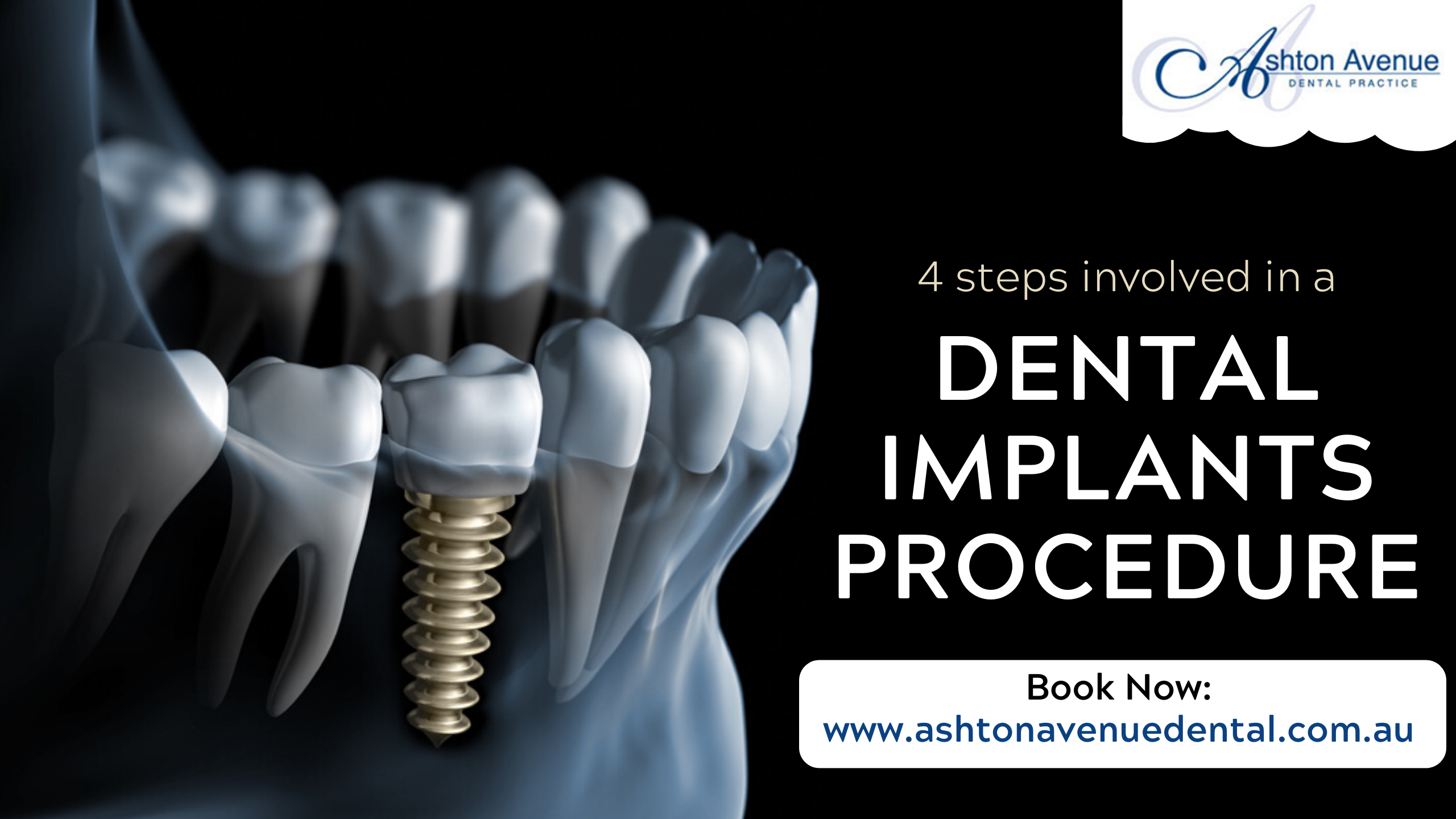 Dental Implant Procedure: A Step by Step Guide Video