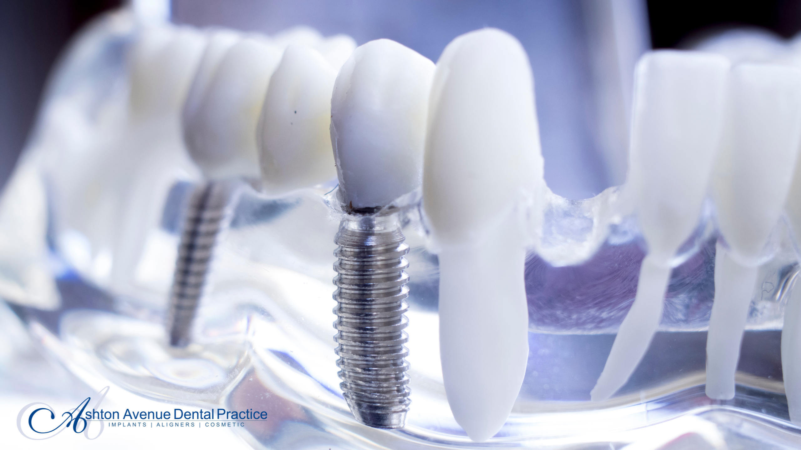 Facts About All-on-4 Dental Implants