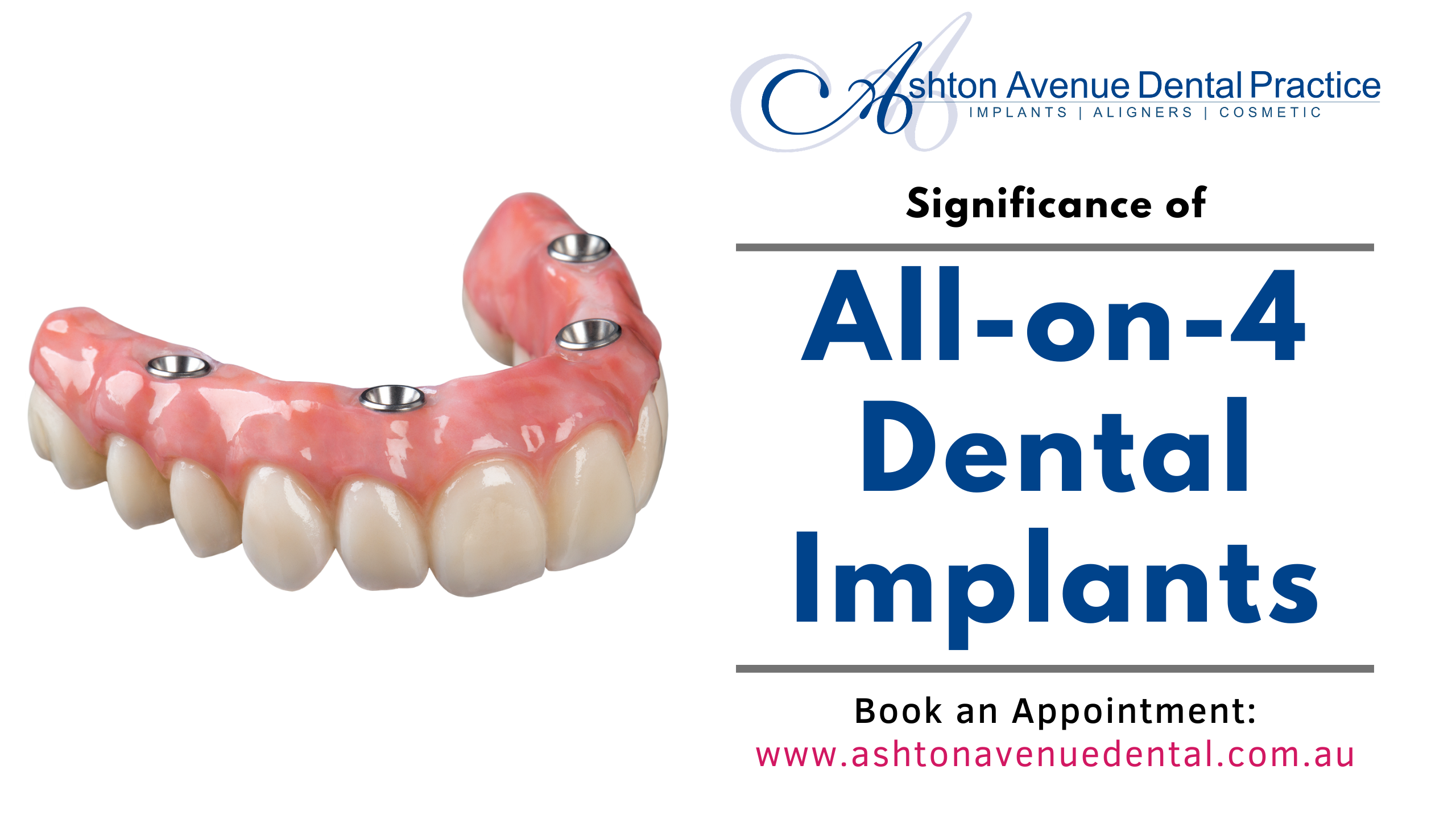 Significance of All-on-4 Dental Implants | Ashton Avenue Dental Practice