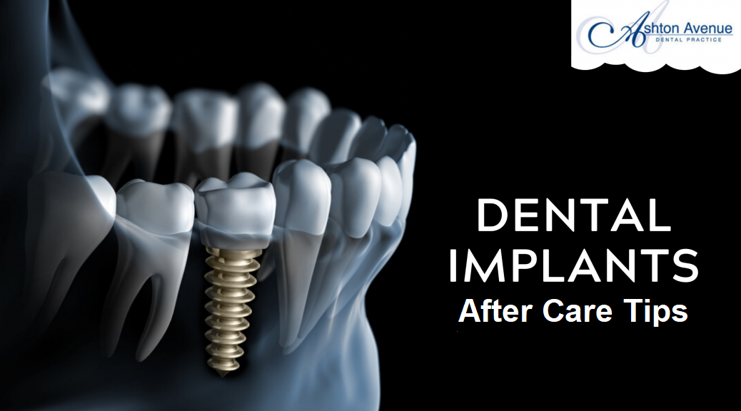 Dental Implants After Care Tips at Home