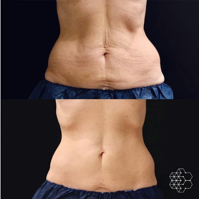 Get a Flatter Tummy Faster – 4 Tips That Can Help