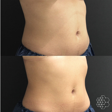 Reduce Your Waist This 2022 – 4 Things You Can Do