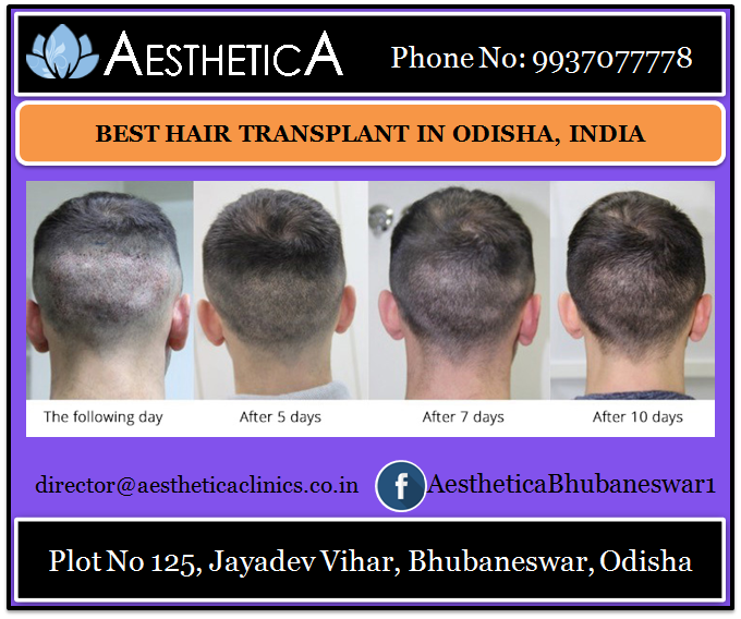 Best Hair Transplant in India