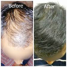 BEST HAIR TRANSPLANT IN INDIA WITH AESTHETICA