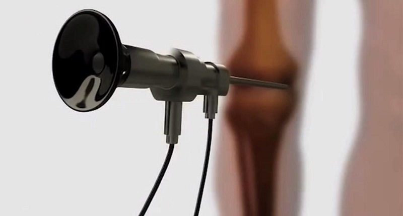 Arthroscopy Devices Market is Growing CAGR of 8.9% by 2026 | Biggest Innovation to Boost CONMED Corporation, Johnson & Johnson Services inc., KARL STORZ GmbH & Co. KG, Medtronic,  Richard Wolf GmbH, Smith & Nephew Plc,  Stryker, Wright Medical Group N.V