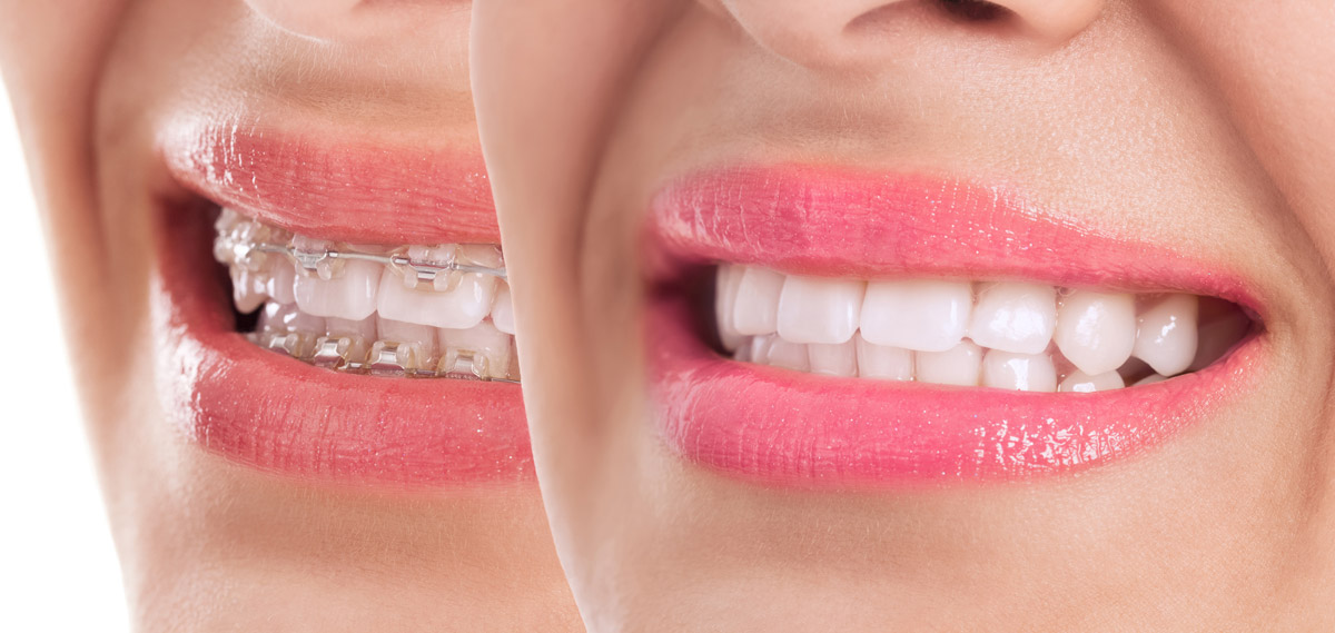 5 Benefits of Having Braces at 40 or Older