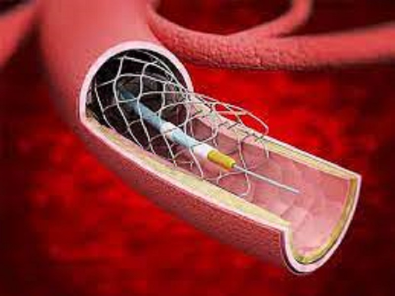 Stents Market Has Exploded: Opportunities & Challenges in Near Future with Key Players like Johnson & Johnson Services, Inc., BD, Biotronik,MicroPort Scientific Corporation