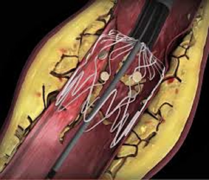 Artery Stenosis Drug Market World’s Leading Business In 2021 - Know Your Abbott, GlaxoSmithKline plc, ALLERGAN, Novartis AG, Merck & Co., Inc, Sanofi, Pfizer Inc, Eli Lilly and Company Till 2026