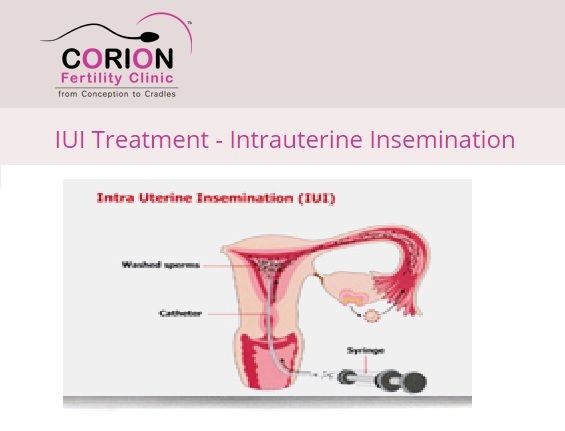 Difference between IUI and IVF you should know