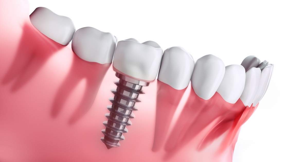 Cheapest Places to Get Dental Implants