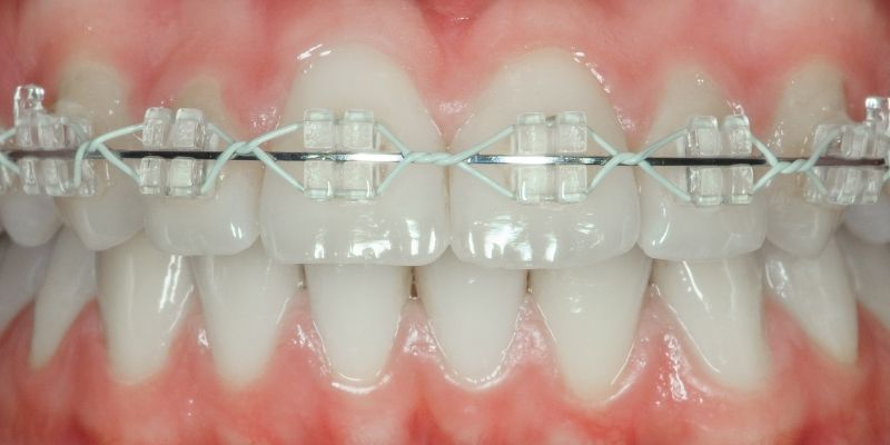 Types of Braces available in Dubai