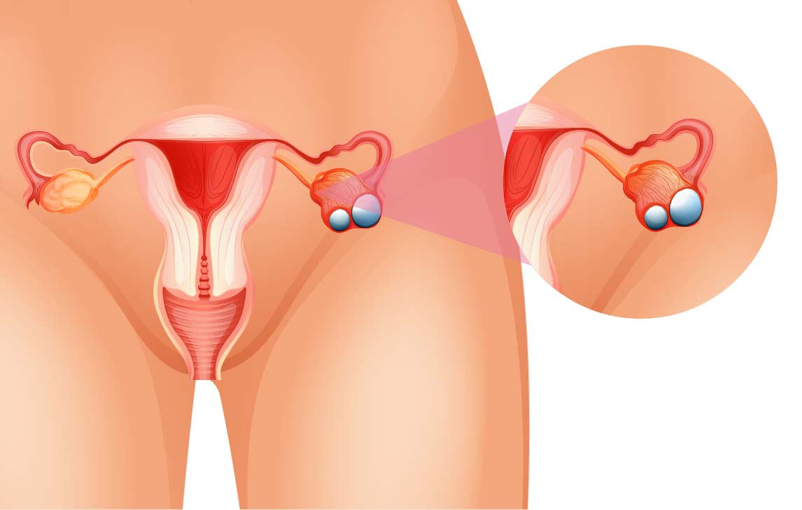 What Are the Risk Factors for Developing Ovarian Cancer?