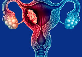3 Ways to Reduce Your Risk of Endometrial Cancer