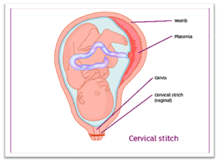 What is Laparoscopic Cervical Cerclage