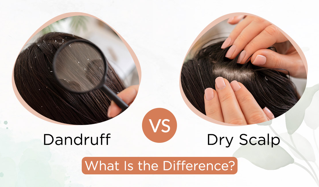 Dandruff Vs Dry Scalp: What Is The Difference?