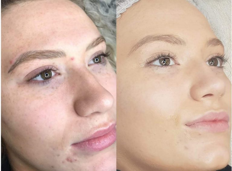 Key Benefit Of BB Glow Facial On Skin