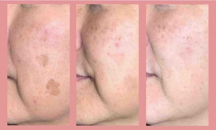 Skin Pigmentation Treatment At Beauty Recipe Singapore