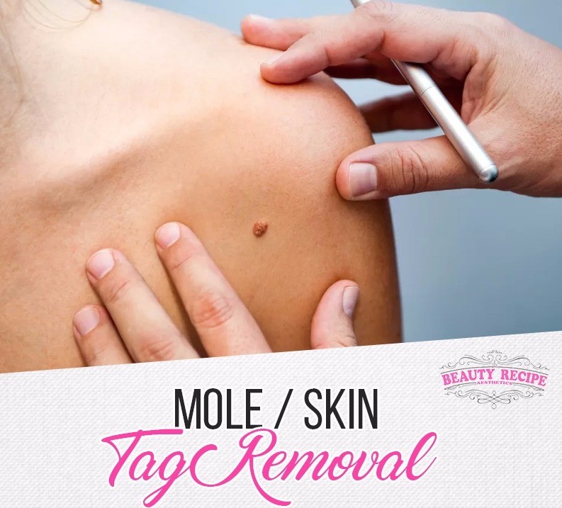 Best Mole Removal In Singapore Using Fusion Plasma Technology