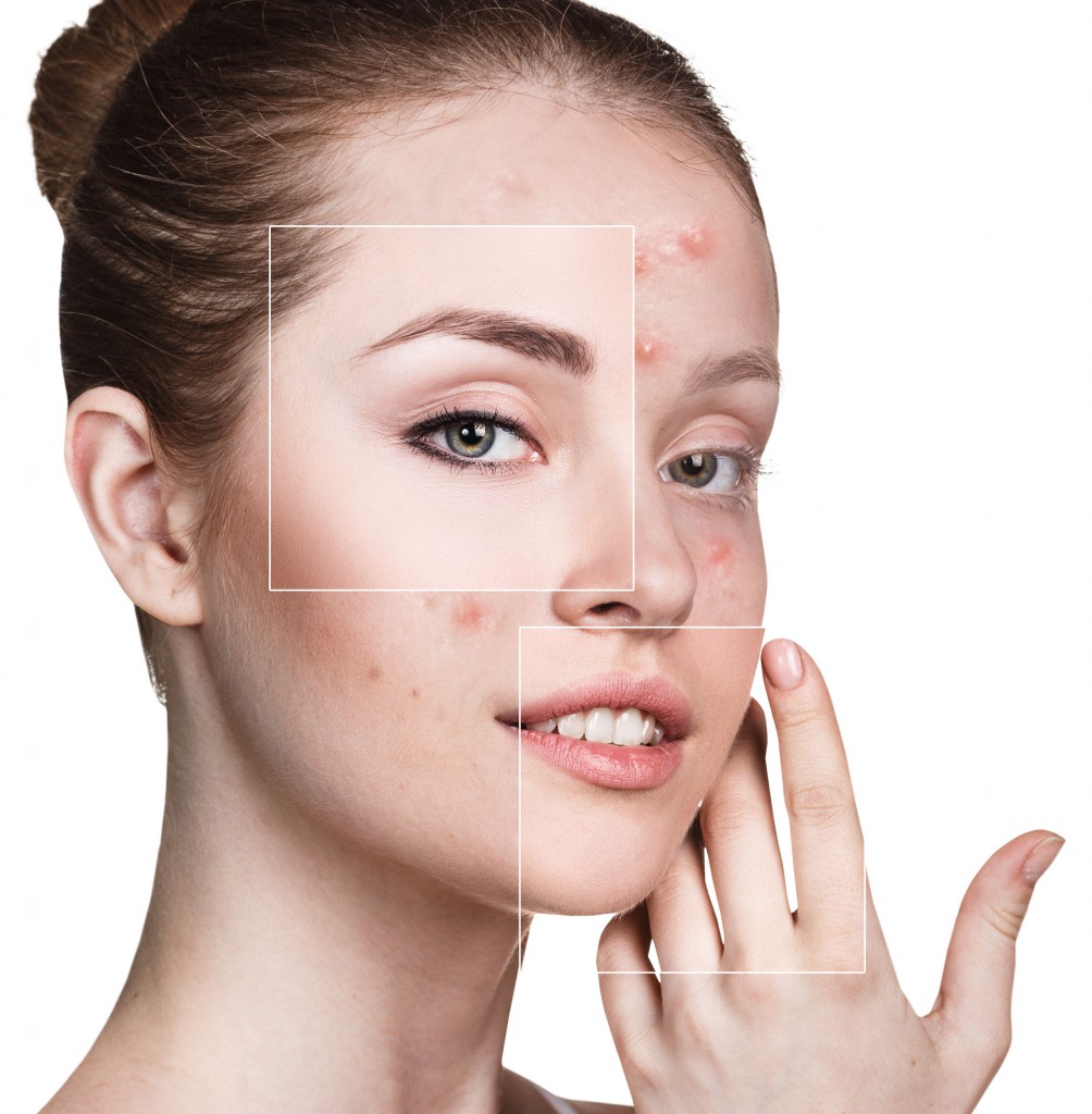 Best Acne Treatment in Hyderabad, Acne Medication & Spot Treatment In India
