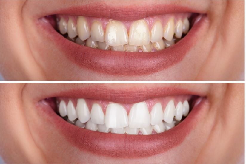 Mobile Teeth Whitening for a Brilliant, Healthy, And Balanced Looking Smile