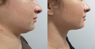 Benefits of Kybella Injections for Chin Fat reduction