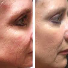 Smooth your skin with the PRP Facial
