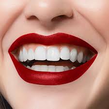 USE Dental Veneers To Achieve A Hollywood Smile