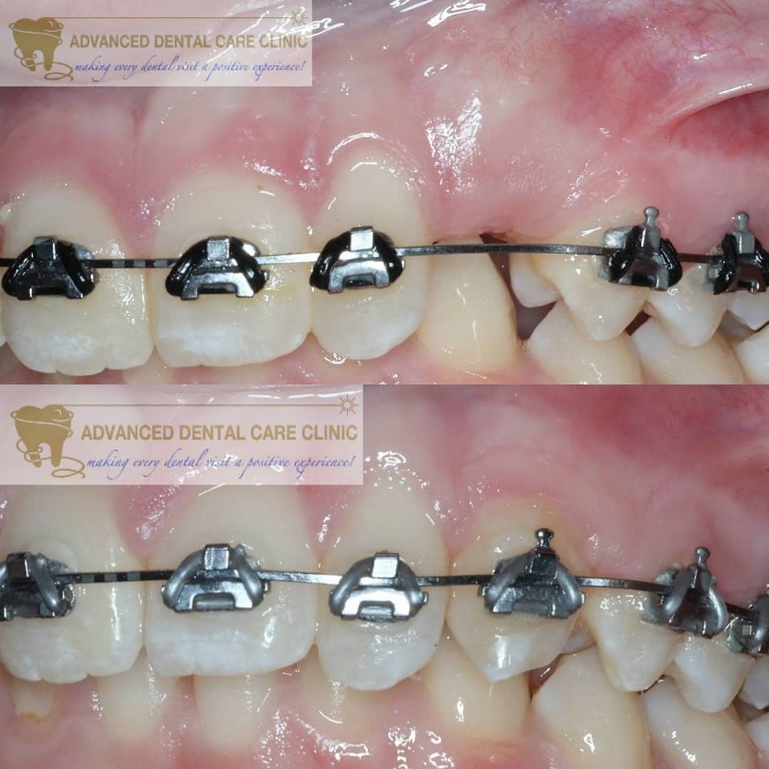 What are you looking for Fast Braces?