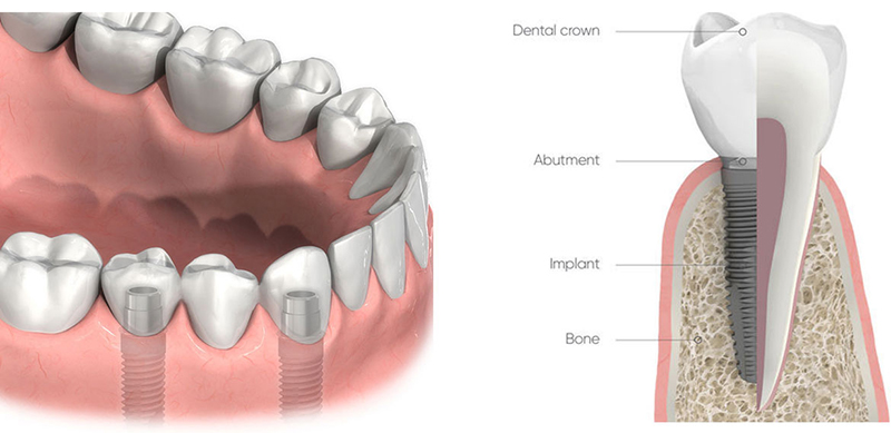 The Best Dental Implants Service In Gold Coast