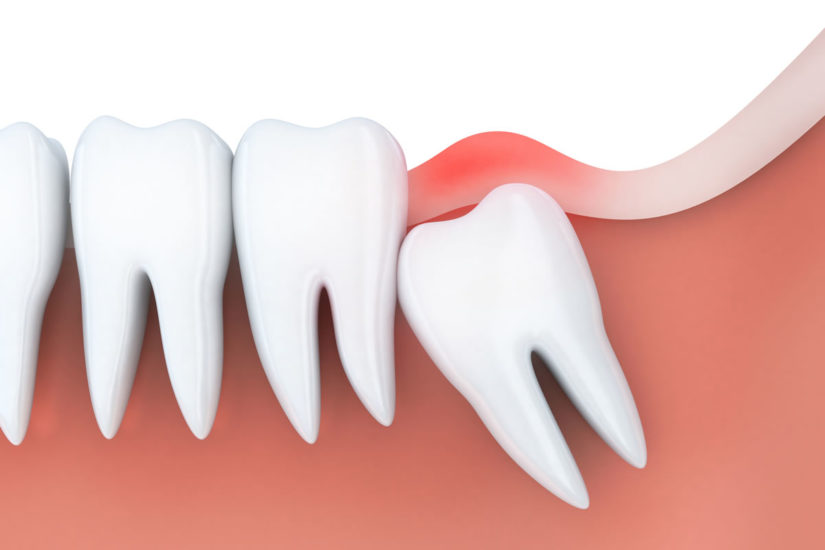Find The Best Quality Wisdom Teeth Removal