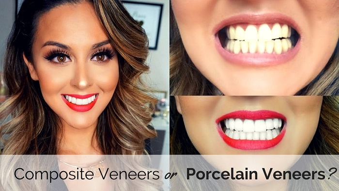 Porcelain Veneers Sydney Bella Vista