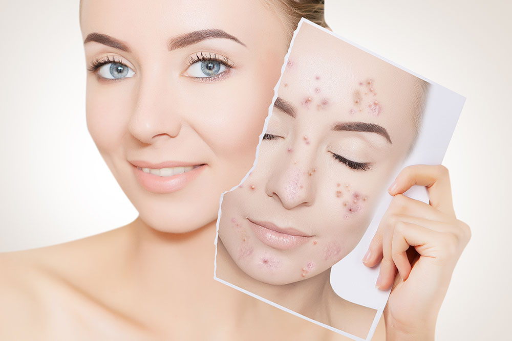 Acne Treatment in Midas Touch - Ahmedabad