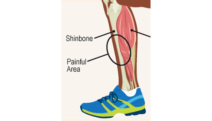 Shin Splint Physiotherapy in Dwarka, Delhi | Pain Free Physiotherapy