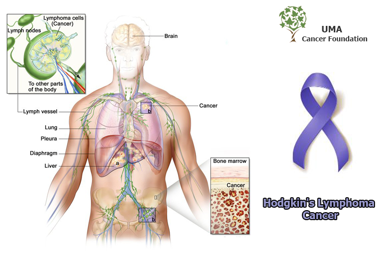 Best cancer treatment in Hyderabad