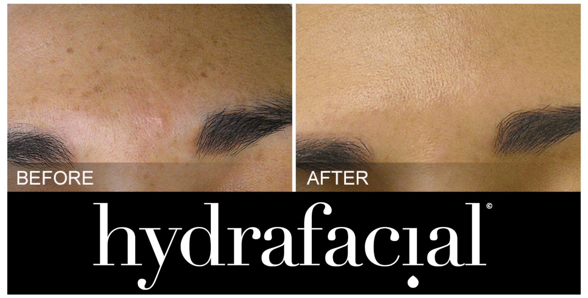 HydraFacial | HydraFacial London | Omniya Clinic London