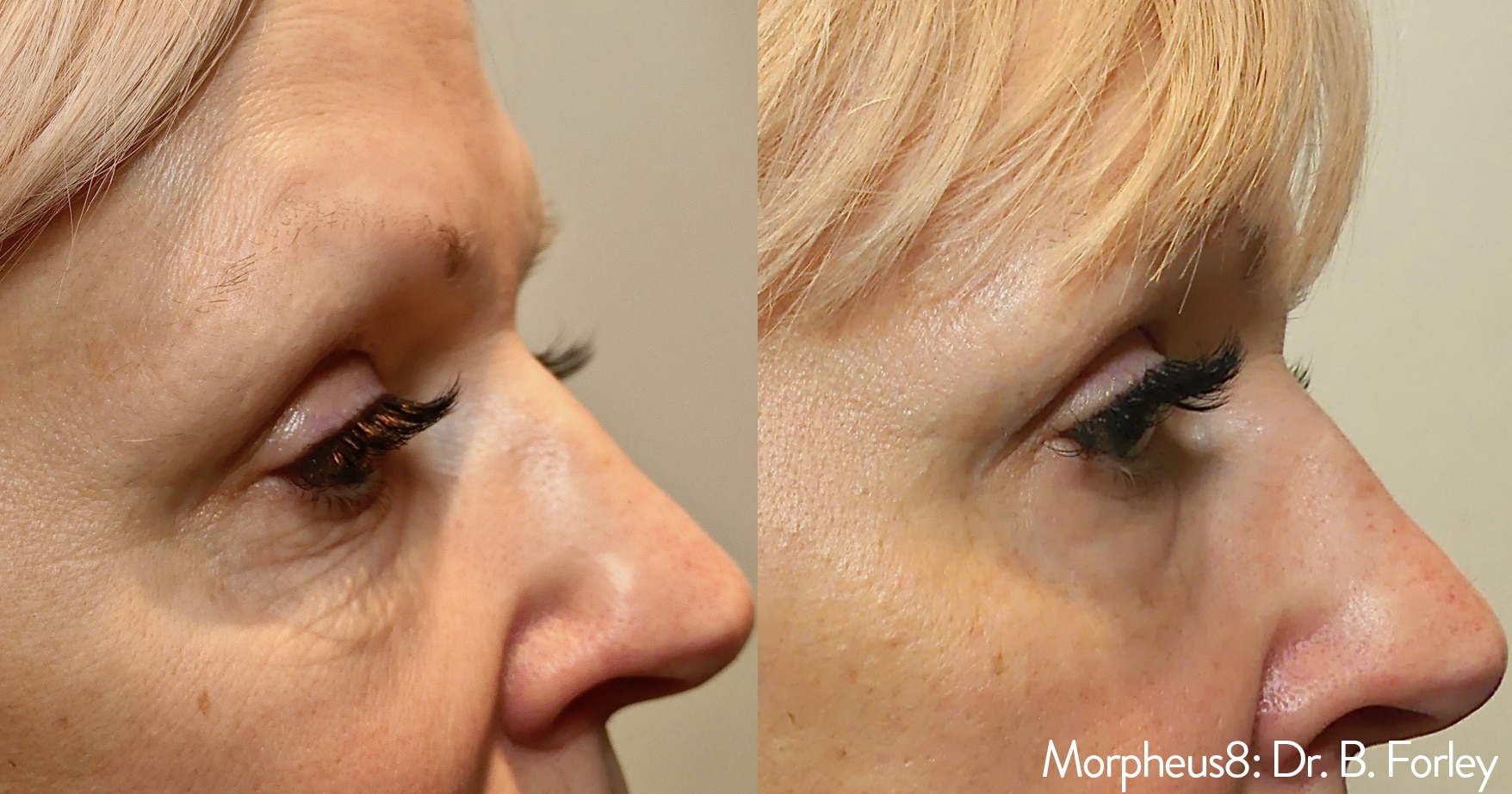 Morpheus8 | Fractional Microneedling | RF | Omniya London